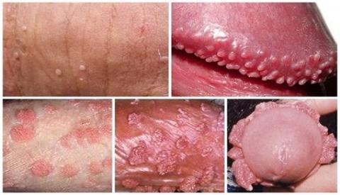 Nổi mụn ở dương vật &ndash; Dấu hiệu cảnh b&aacute;o bệnh nguy hiểm