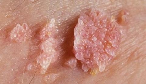 Bệnh s&ugrave;i m&agrave;o g&agrave; c&oacute; tự khỏi được kh&ocirc;ng?