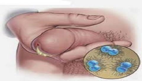 Dương vật ra mủ - Dấu hiệu cảnh báo nguy hiểm