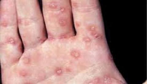 Các giai đoạn giang mai