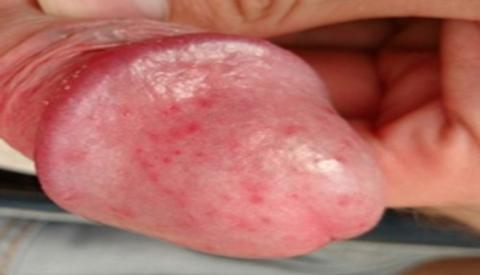 Đầu dương vật nổi mẩn đỏ - Dấu hiệu cảnh báo nguy hiểm