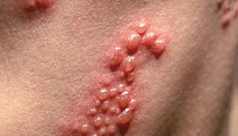 Mụn nước sinh dục &ndash; Căn bệnh nguy hiểm, chớ dại chủ quan