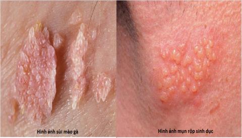 Nguy&ecirc;n nh&acirc;n g&acirc;y mụn ở bộ phận sinh dục v&agrave; c&aacute;ch điều trị hiệu quả