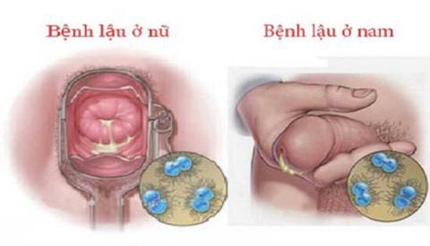 Tìm hiểu về bệnh lậu và cách chữa hiệu quả tránh biến chứng