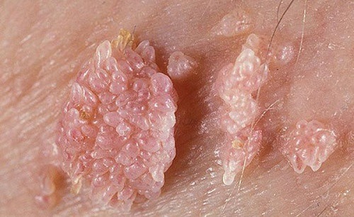 u nhú mụn rộp sinh dục