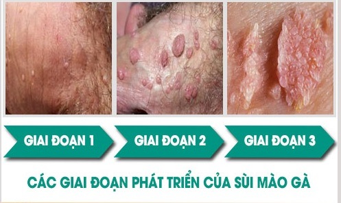 các giai đoạn phát triển của bệnh sùi mào gà